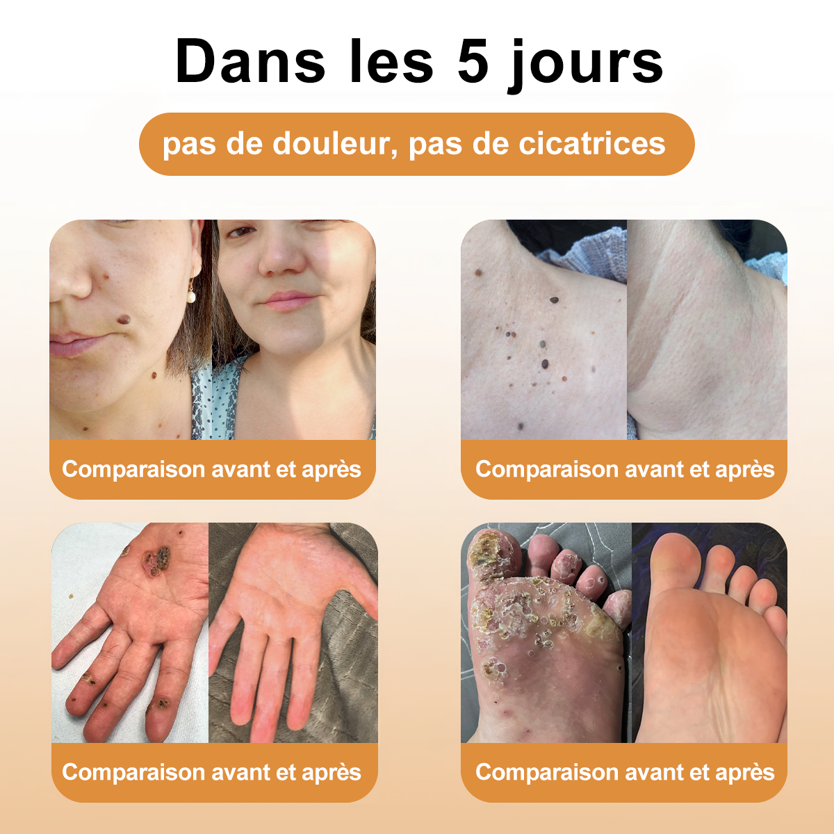 Diystar™ Crème Soin Expert pour Verrues et Grains de Beauté au Venin d’Abeille (Recommandée par la SFD 👩⚕)