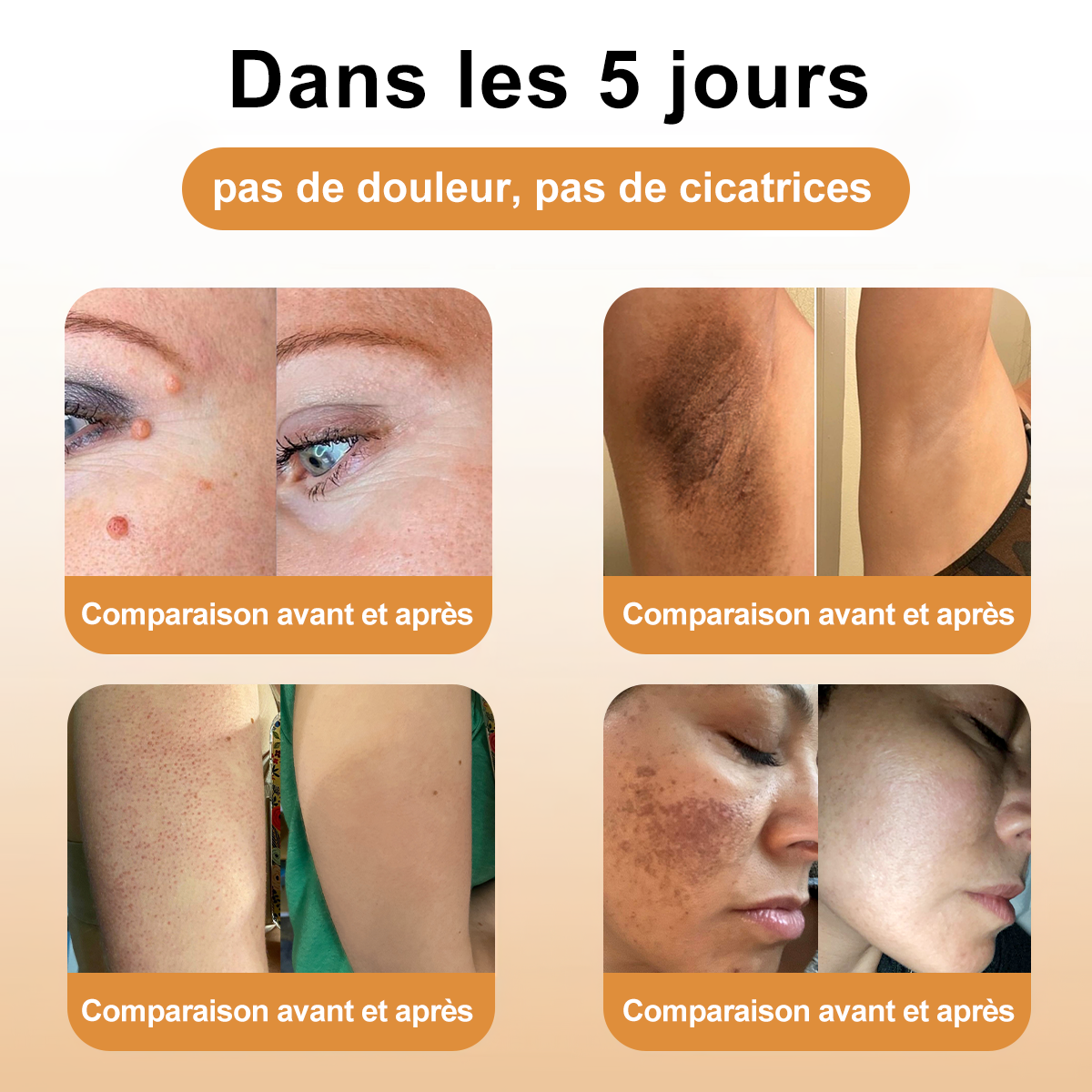 Diystar™ Crème Soin Expert pour Verrues et Grains de Beauté au Venin d’Abeille (Recommandée par la SFD 👩⚕)