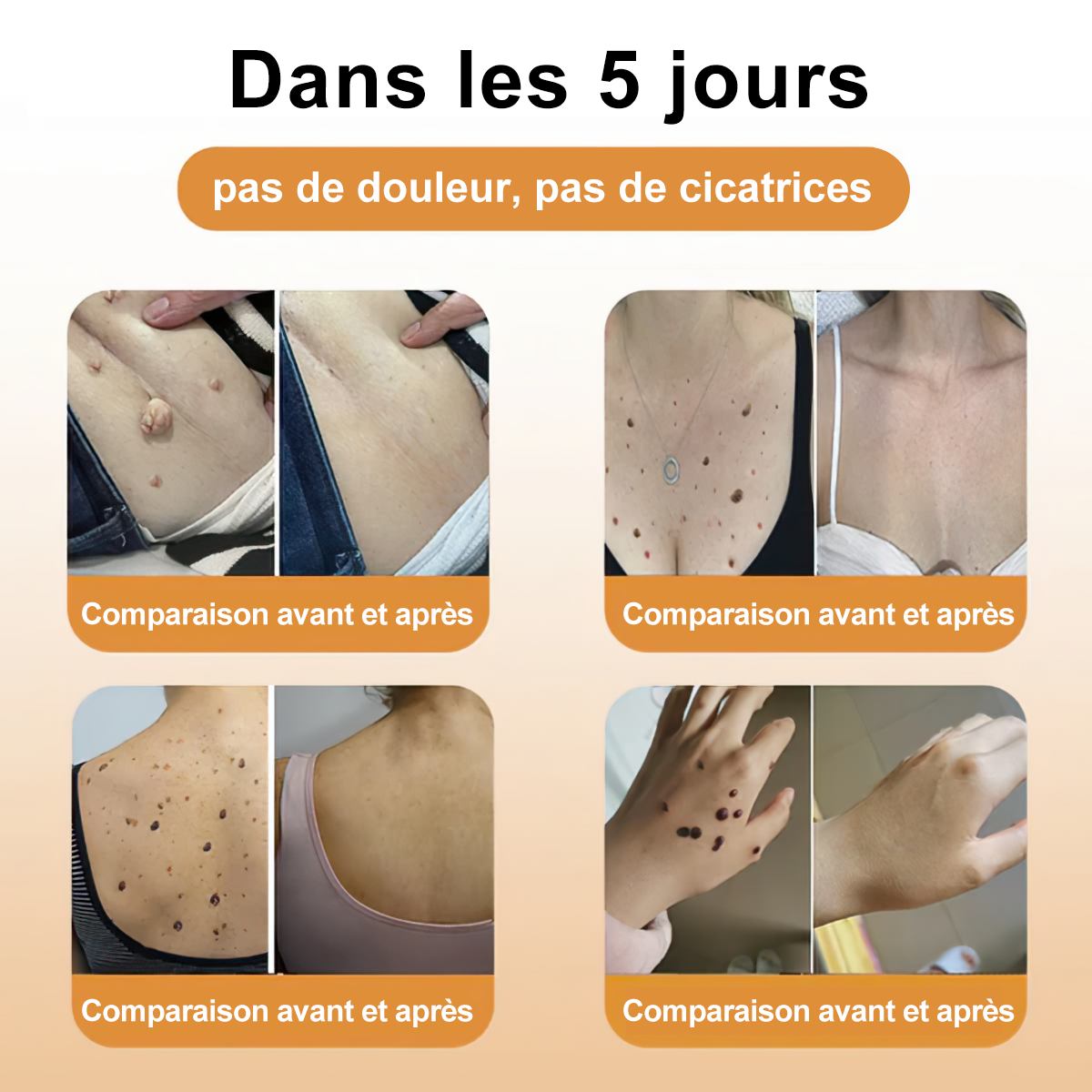 Diystar™ Crème Soin Expert pour Verrues et Grains de Beauté au Venin d’Abeille (Recommandée par la SFD 👩⚕)