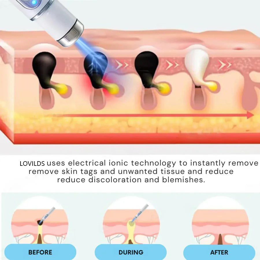 LOVILDS™ Stylo Laser Non Invasif pour l’Élimination des Grains de Beauté et des Verrues