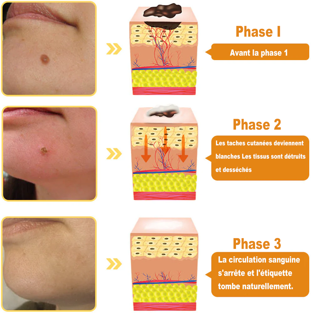 Diystar™ Crème Soin Expert pour Verrues et Grains de Beauté au Venin d’Abeille (Recommandée par la SFD 👩⚕)