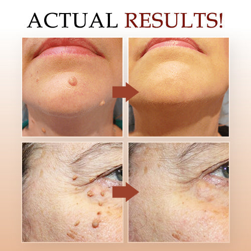 LOVILDS™ Correcteur Naturel aux Herbes pour Grains de Beauté et Verrues
