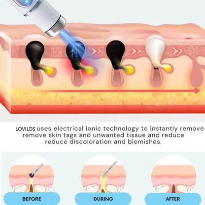 LOVILDS™ Stylo Laser Non Invasif pour l’Élimination des Grains de Beauté et des Verrues