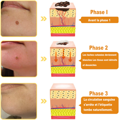 Diystar™ Crème Soin Expert pour Verrues et Grains de Beauté au Venin d’Abeille (Recommandée par la SFD 👩‍⚕)