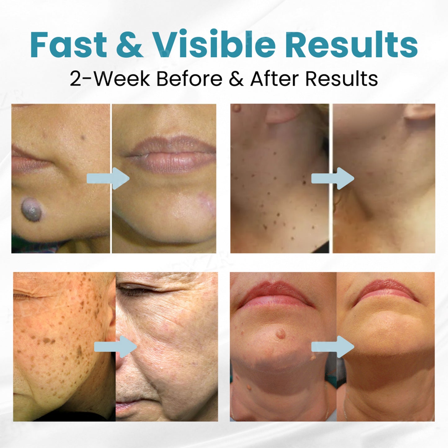 LOVILDS™ Stylo Laser Non Invasif pour l’Élimination des Grains de Beauté et des Verrues