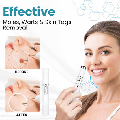LOVILDS™ Stylo Laser Non Invasif pour l’Élimination des Grains de Beauté et des Verrues